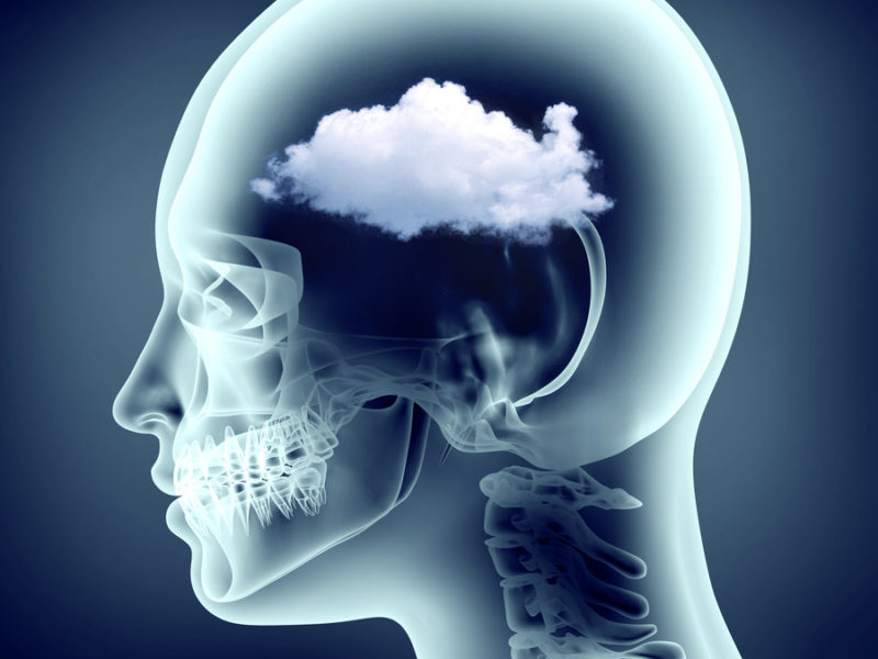 brain fog x-ray