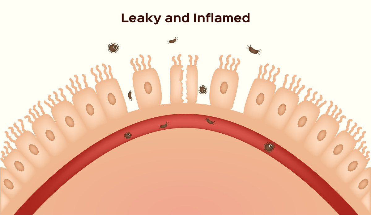 Coeliac disease or celiac disease | What Is Leaky Gut Syndrome And How Does It Affect Your Health?